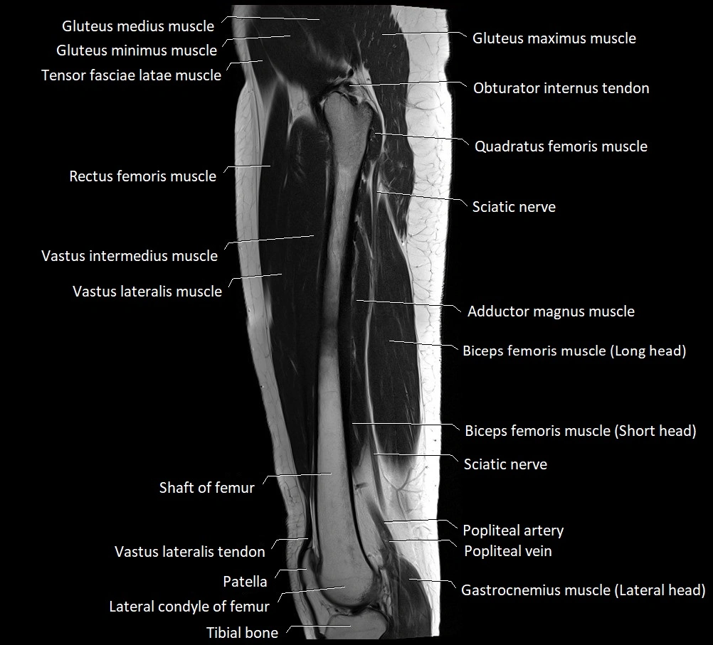 Thigh sagittal cross sectional anatomy MRI 3T image 8.webp